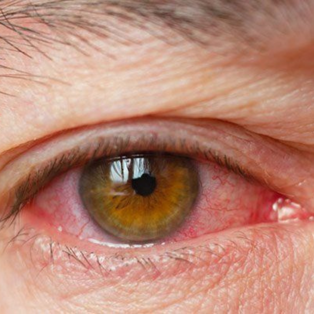 A Guide on Contact Lenses for Dry Eyes: Causes and Prevention