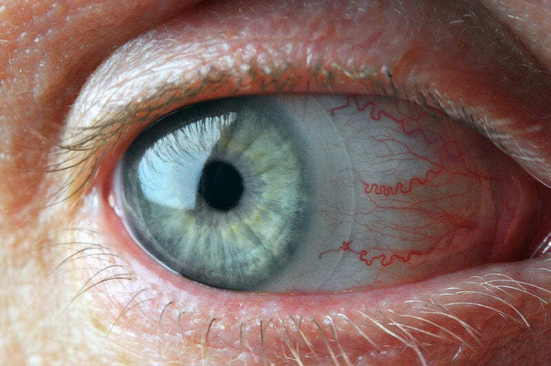 Contact Lens Overwear Syndrome: Symptoms, What to Do and How to Recover